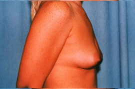 Breast Augmentation Patient 90070 Before Photo # 5