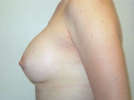Breast Augmentation Patient 23082 After Photo # 4