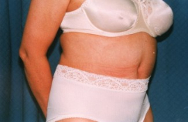Tummy Tuck Patient 19101 After Photo # 2