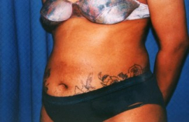 Tummy Tuck Patient 26227 Before Photo # 3