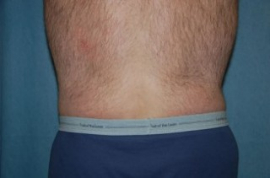 Body Lift Patient 45266 After Photo # 2