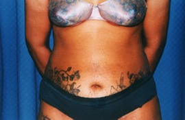 Tummy Tuck Patient 26227 Before Photo # 1