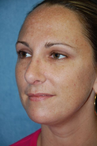 Chin Augmentation Patient 27625 After Photo # 2