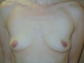 Breast Augmentation Patient 20748 Before Photo # 3