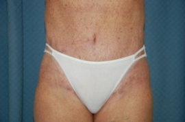 Body Lift Patient 42627 After Photo # 2