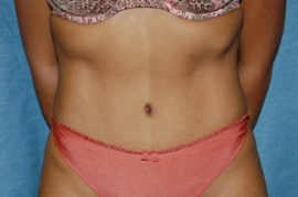 Tummy Tuck Patient 55304 After Photo # 2