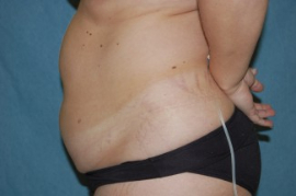 Liposuction Patient 79601 Before Photo # 5