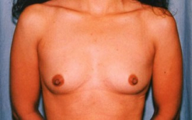 Breast Augmentation Patient 94910 Before Photo # 1