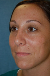 Chin Augmentation Patient 68370 After Photo # 2