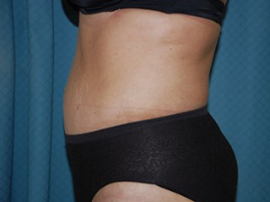 Body Lift Patient 56396 After Photo # 6