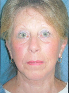 Injectables Patient 27314 After Photo # 2