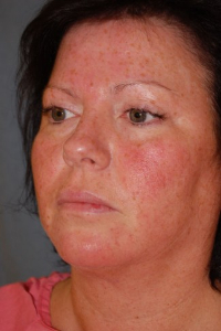 Eye Lift - Blepharoplasty Patient 60760 Before Photo # 5