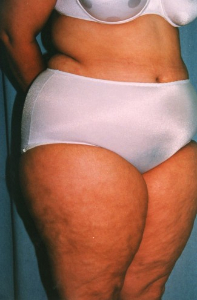 Liposuction Patient 25577 Before Photo # 3