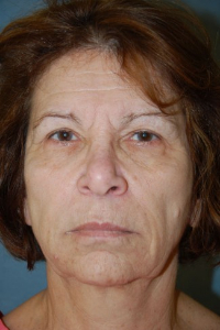 Forehead Lift - Browlift Patient 75315 Before Photo # 1