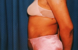 Tummy Tuck Patient 26227 After Photo # 6