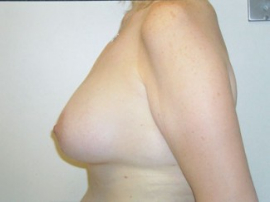 Breast Augmentation and Lift Patient 31680 After Photo # 4
