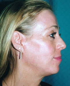 Face Lift and Neck Lift Patient 53606 After Photo # 2