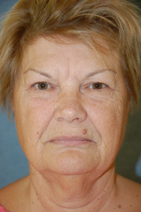 Face Lift and Neck Lift Patient 74597 Before Photo # 1