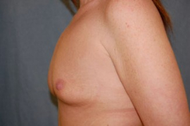 Breast Augmentation Patient 34919 Before Photo # 5