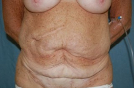 Body Lift Patient 42627 Before Photo # 1