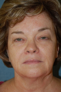 Face Lift and Neck Lift Patient 27540 Before Photo # 1