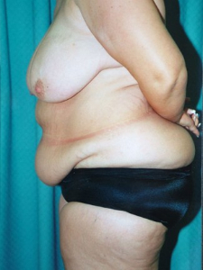 Breast Enhancement and Tummy Tuck Patient 97467 Before Photo # 3
