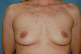 Breast Augmentation Patient 89092 Before Photo # 1