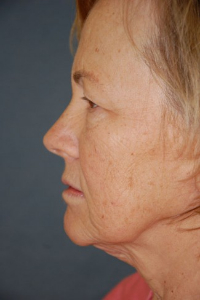 Face Lift and Neck Lift Patient 49297 Before Photo # 5