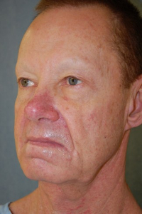 Facial Surgery - (Men) Patient 29963 Before Photo # 5