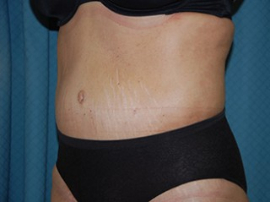Body Lift Patient 56396 After Photo # 4