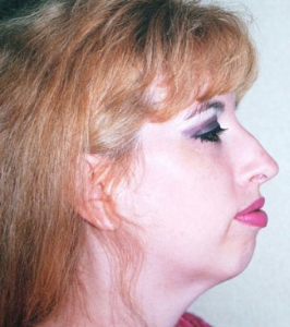 Rhinoplasty Patient 60017 Before Photo # 1