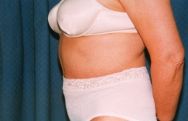 Tummy Tuck Patient 19101 After Photo # 6