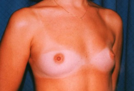 Breast Augmentation Patient 60985 Before Photo # 1