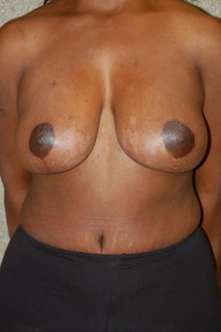 Breast Enhancement and Tummy Tuck Patient 39346 After Photo # 2