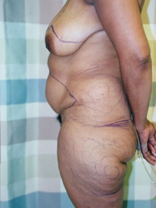 Breast Lift Patient 62255 Before Photo # 1