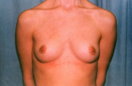 Breast Augmentation Patient 75917 Before Photo # 1