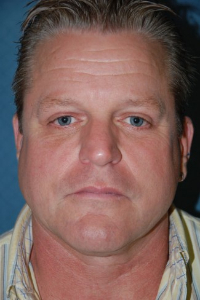 Patient # 83947 Before Photo # 1