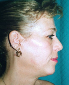 Face Lift and Neck Lift Patient 53606 Before Photo # 1