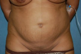 Tummy Tuck Patient 55304 Before Photo # 1