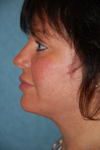 Face Lift and Neck Lift Patient 15871 After Photo # 4