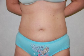 Liposuction Patient 79601 After Photo # 2