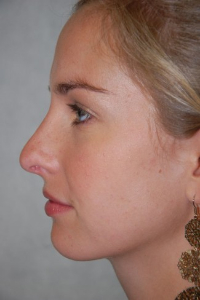 Rhinoplasty Patient 65711 After Photo # 6