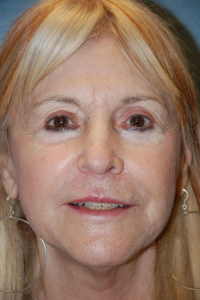 Face Lift - (greater than 80 years old) Patient 30019 After Photo # 2