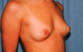 Breast Augmentation Patient 50181 Before Photo # 1