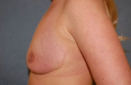 Breast Augmentation and Lift Patient 37400 Before Photo # 1