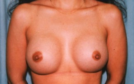 Breast Augmentation Patient 94910 After Photo # 2