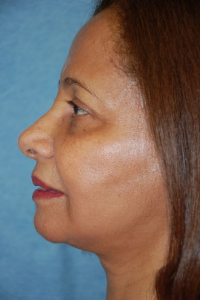 Face Lift and Neck Lift Patient 43313 After Photo # 6