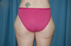 Body Lift Patient 69575 After Photo # 2