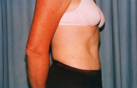 Tummy Tuck Patient 65833 After Photo # 6
