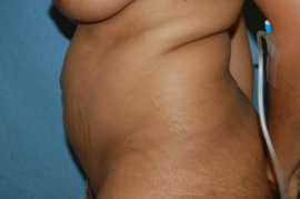 Tummy Tuck Patient 55304 Before Photo # 5
